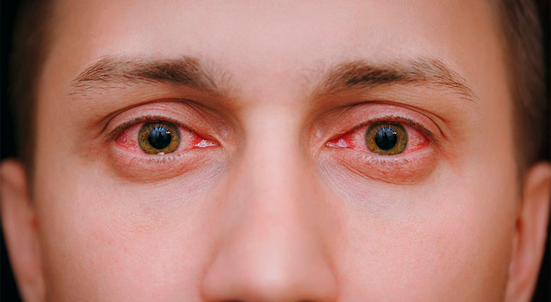 Conjuntivitis alérgica